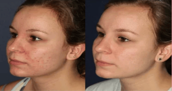 Before & After Results of Blue Led Face Mask Online