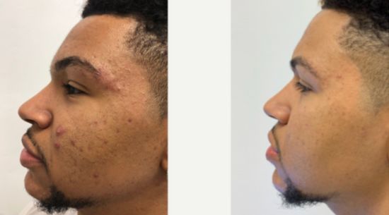 Before and After Results of DermForge Supplements