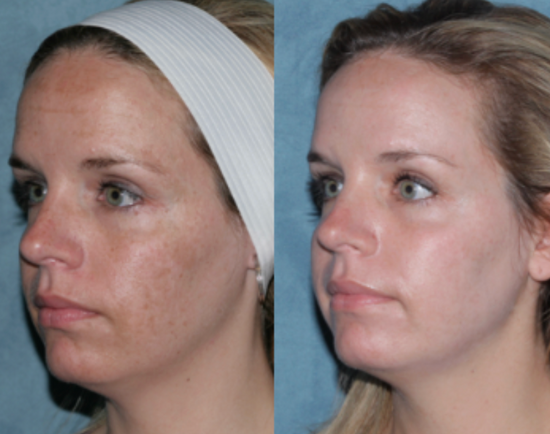 Before & After Results of DermForge Skincare