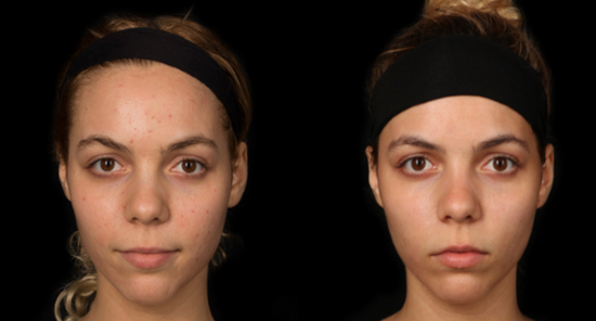 Before and After Results of Blue Light Face Mask