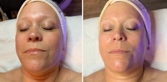 DermForge LED Mask Before and After