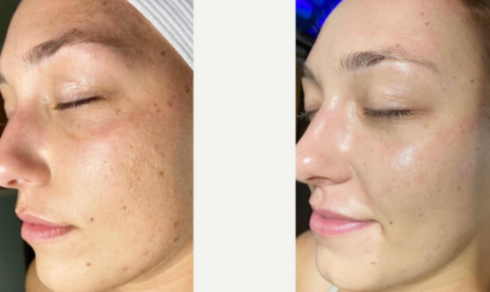 Before and After Result of DermForge Skincare